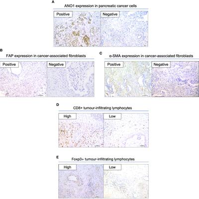 High ANO1 expression is a prognostic factor and correlated with an immunosuppressive tumor microenvironment in pancreatic cancer